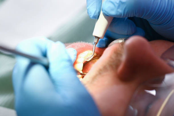 Best Emergency Tooth Extraction in Stanford, CA