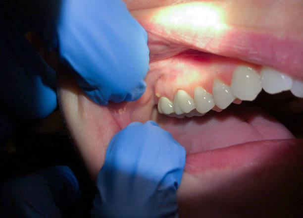 Best Emergency Gum Treatment in Stanford, CA