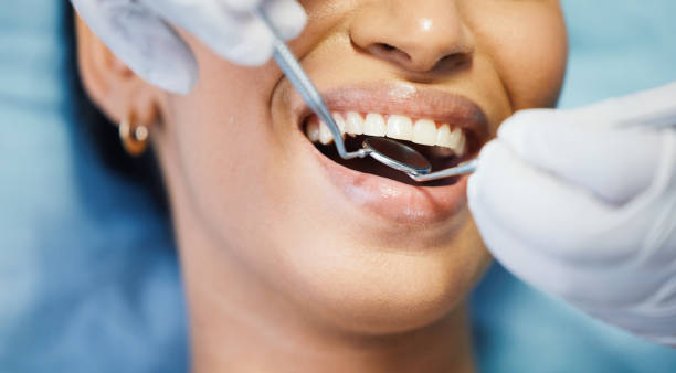 Best Emergency Tooth Extraction in Stanford, CA